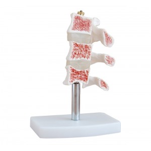 http://www.yuantech.de/246-292-thickbox/ya-l034-osteoporosis-model.jpg