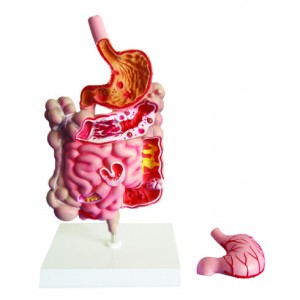 http://www.yuantech.de/301-616-thickbox/ya-d013-diseased-digestive-system-model.jpg