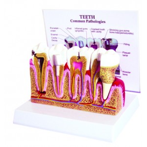 http://www.yuantech.de/329-635-thickbox/ya-d054-dental-pulp-disease-model.jpg