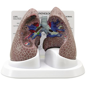 http://www.yuantech.de/341-397-thickbox/ya-r045-diseased-lung-model.jpg