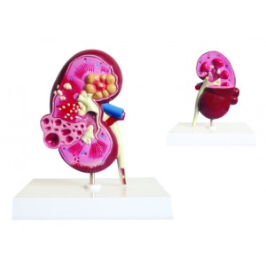 http://www.yuantech.de/359-660-thickbox/ya-u023-kidney-and-cyst-model.jpg