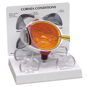 http://www.yuantech.de/442-724-thickbox/ya-s036-diseased-cornea-model.jpg