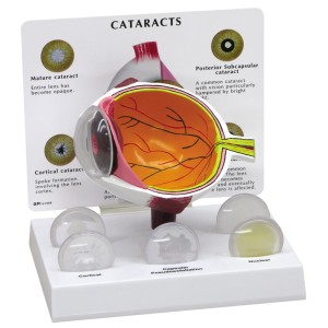 http://www.yuantech.de/443-725-thickbox/ya-s037-cataract-model.jpg
